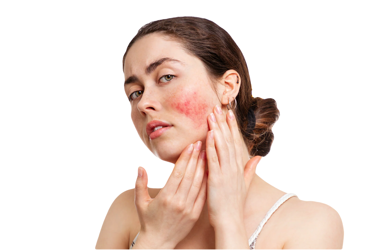 Redness and Rosacea