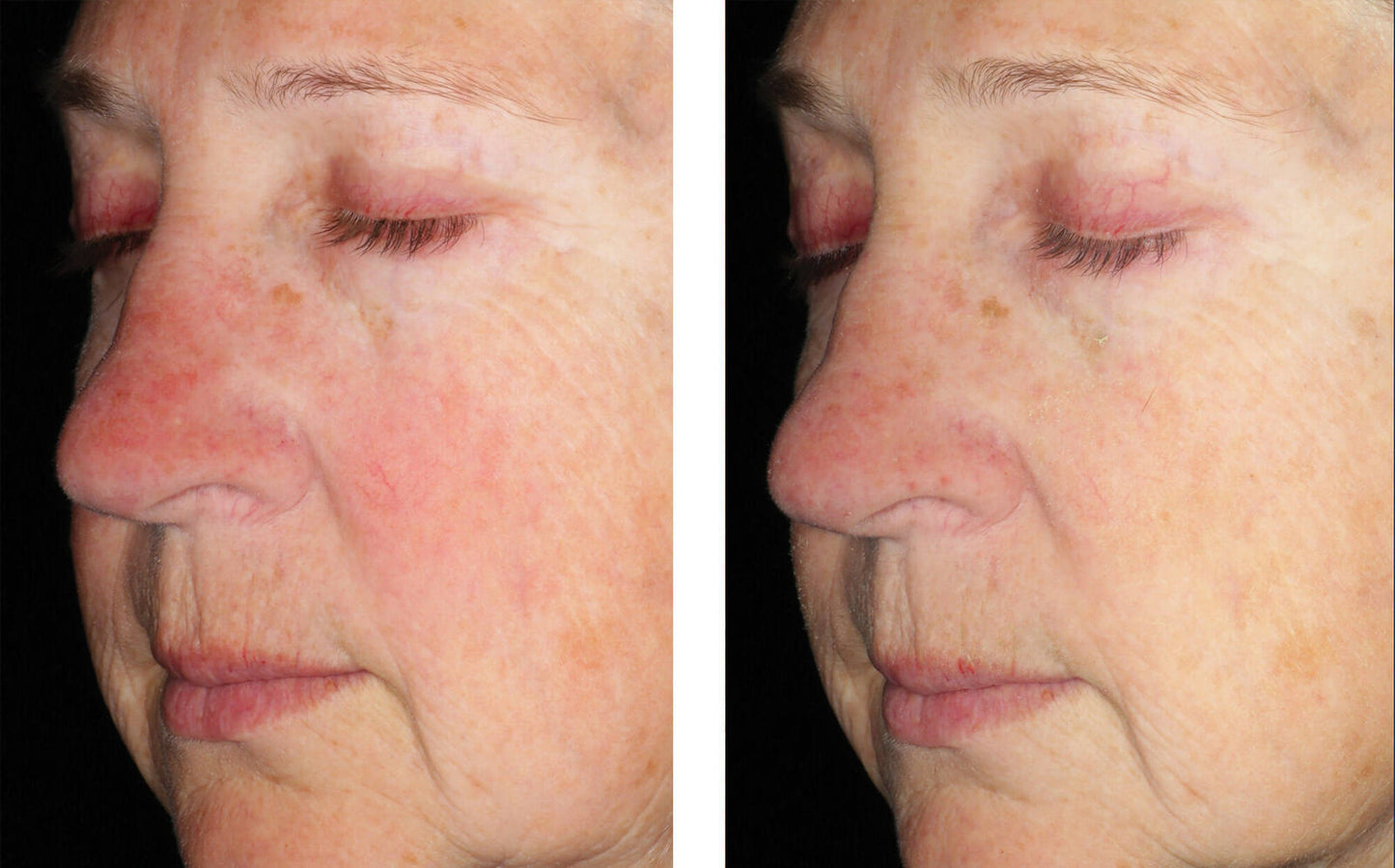 BEFORE / AFTER 4 WEEKS, TWICE-DAILY USE