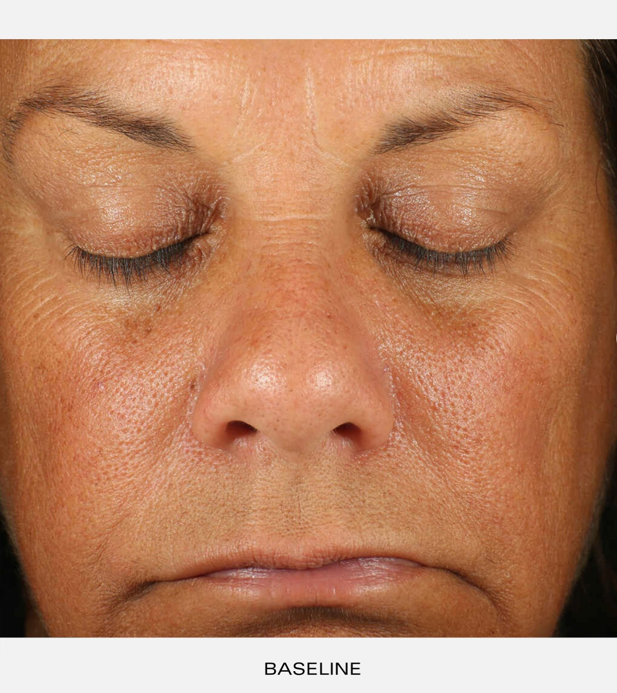A 12-week independent third-party clinical study of 46 participants to assess the efficacy potential of Retinol Skin Brightener. Participants represent females, ages 40-64, with Fitzpatrick skin types II-IV. Supported with the use of Gentle Cleanser, Sunscreen + Primer Broad-Spectrum SPF 30 and Hydrating Crème during the study. Duration 12 Weeks