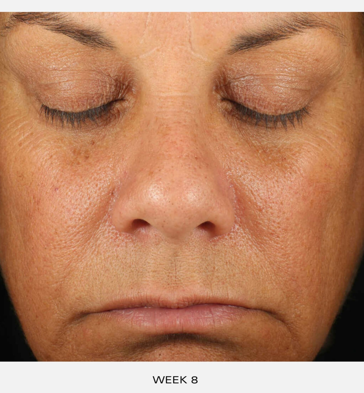 A 12-week independent third-party clinical study of 46 participants to assess the efficacy potential of Retinol Skin Brightener. Participants represent females, ages 40-64, with Fitzpatrick skin types II-IV. Supported with the use of Gentle Cleanser, Sunscreen + Primer Broad-Spectrum SPF 30 and Hydrating Crème during the study. Duration 12 Weeks