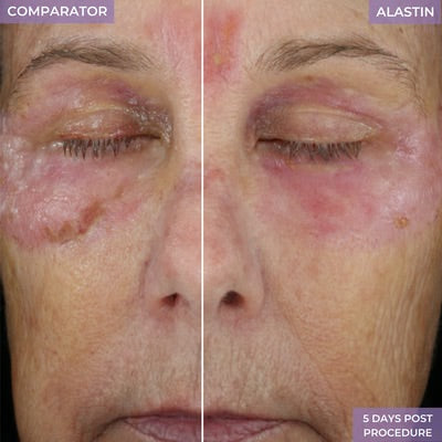 Alastin Procedure Enhancement System