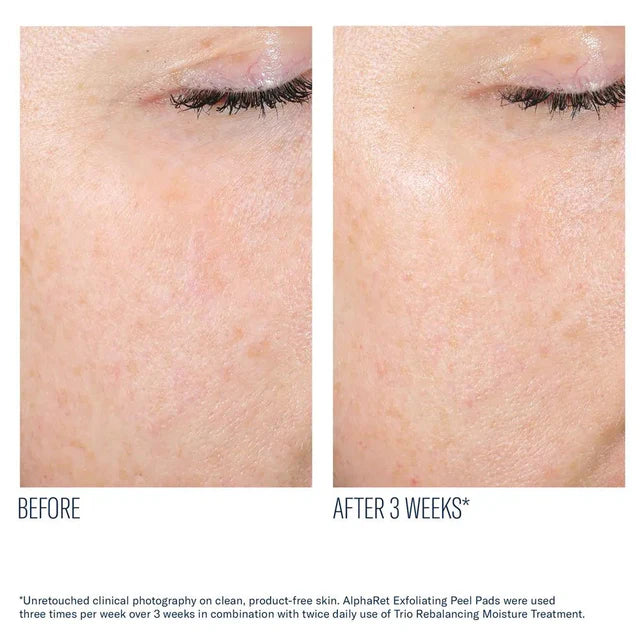 AlphaRet Exfoliating Peel Pads